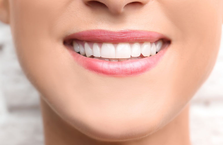 Bonding dentale