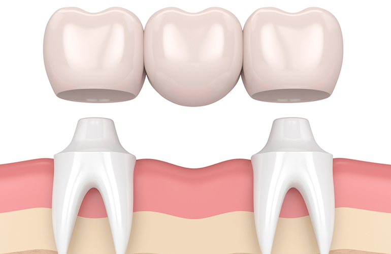 Brighe dentali