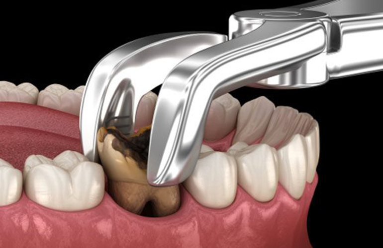 Estrazione di denti