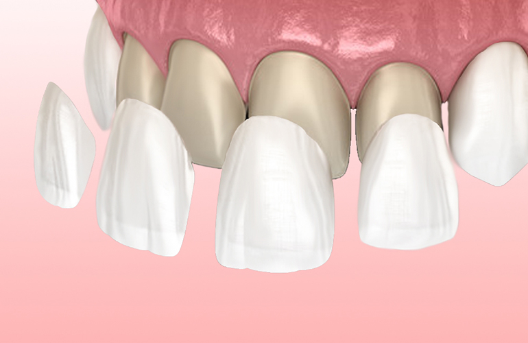 Faccette dentali