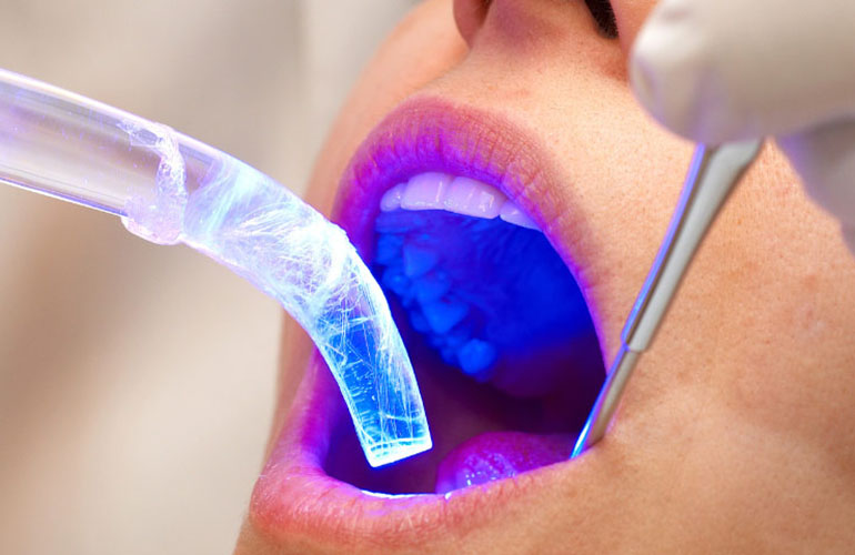 Il laser odontoiatrico