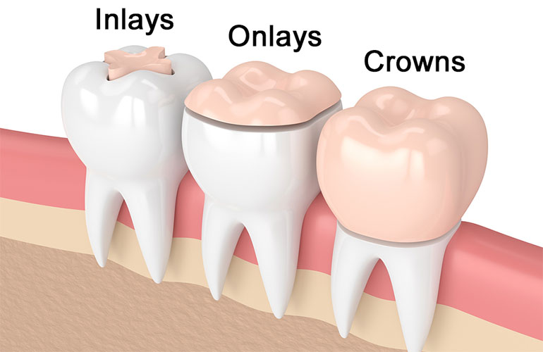Inlays & Onlays