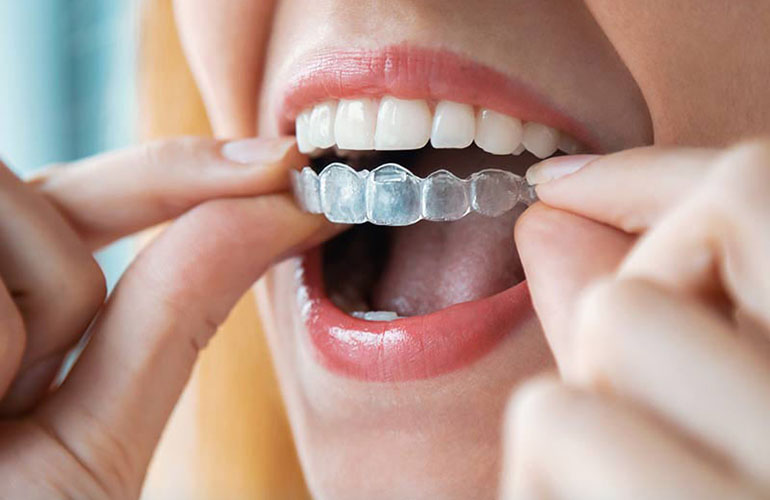 Invisalign
