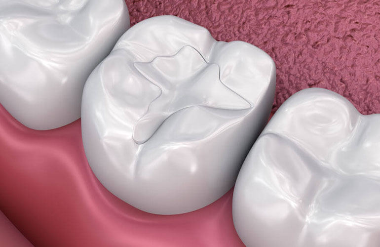 Otturazioni dentali