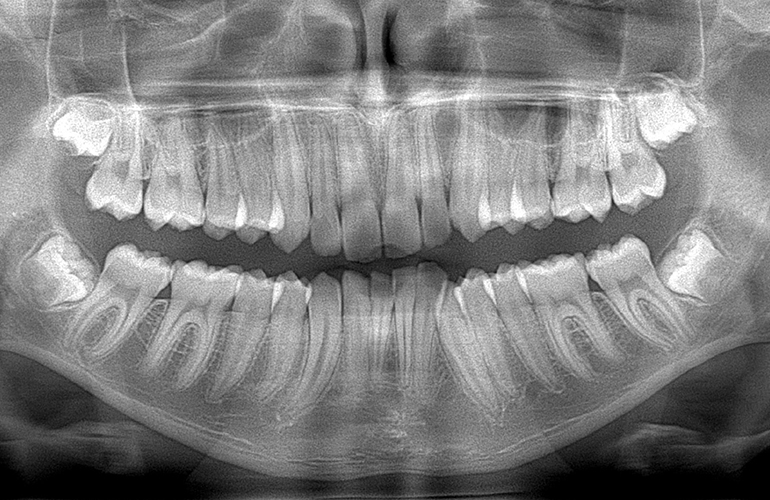 Radiografia dentale