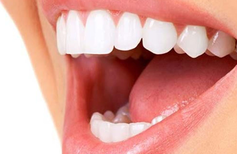 Rimodellamento dei denti