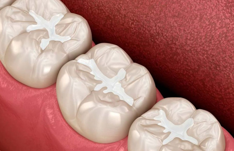 Sigillanti dentali